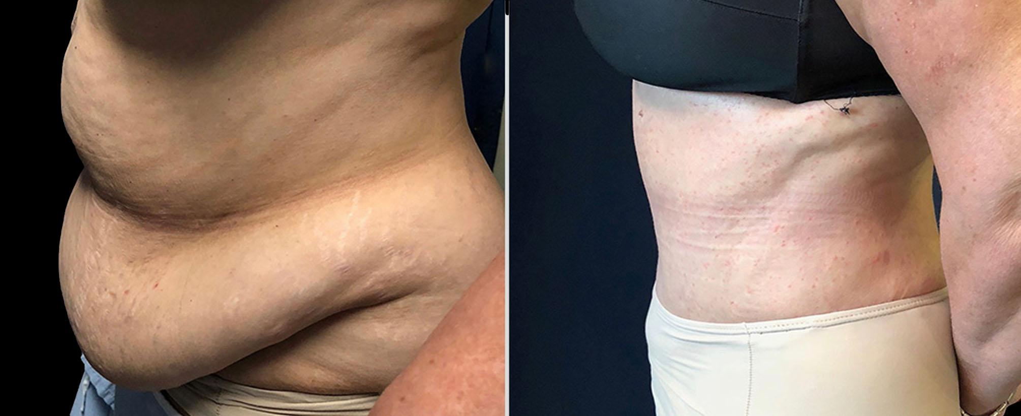 before and after abdominoplasty / tummy tuck