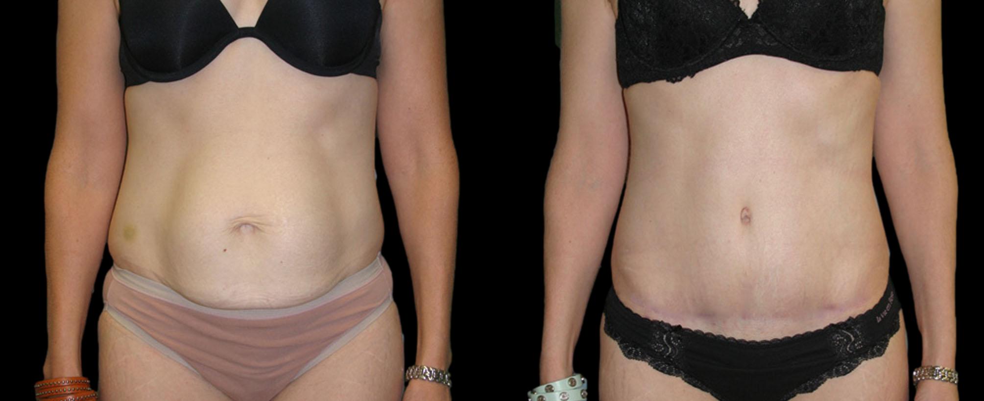 before and after abdominoplasty / tummy tuck