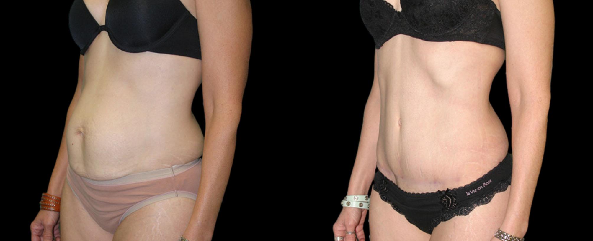 before and after abdominoplasty / tummy tuck