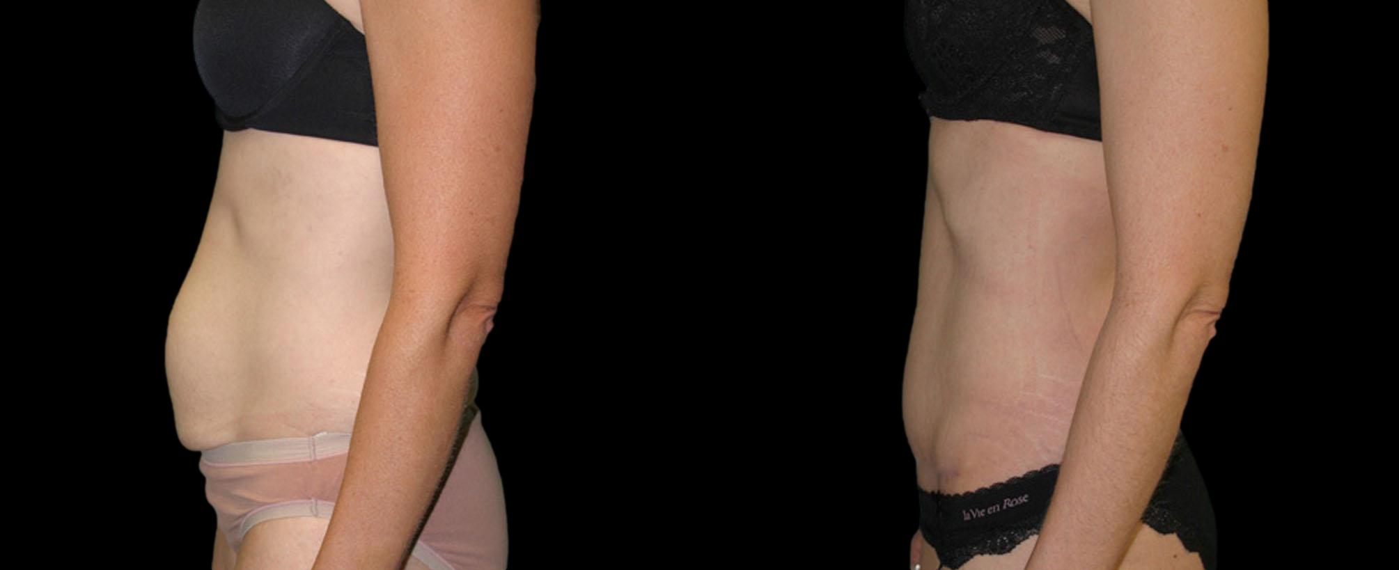 before and after abdominoplasty / tummy tuck