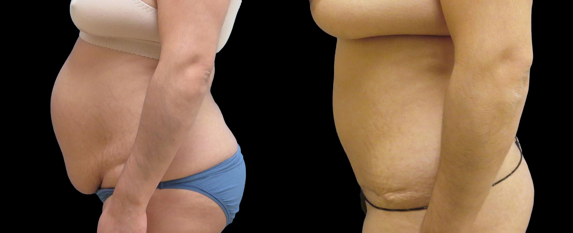 before and after abdominoplasty / tummy tuck