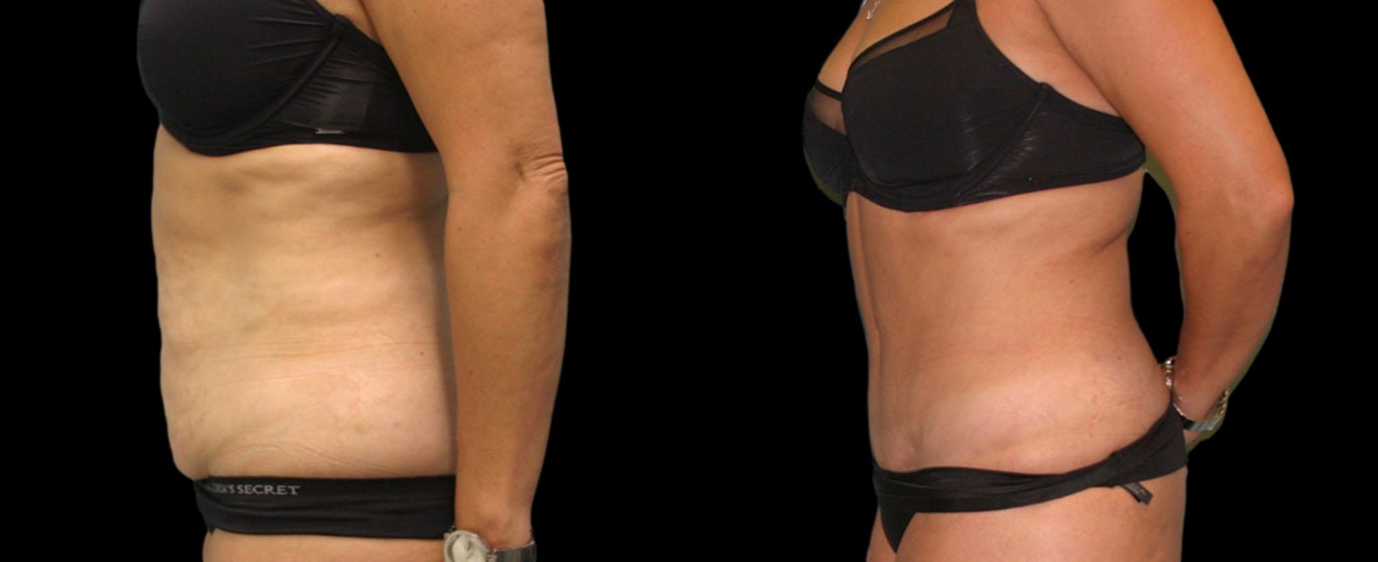 before and after abdominoplasty / tummy tuck