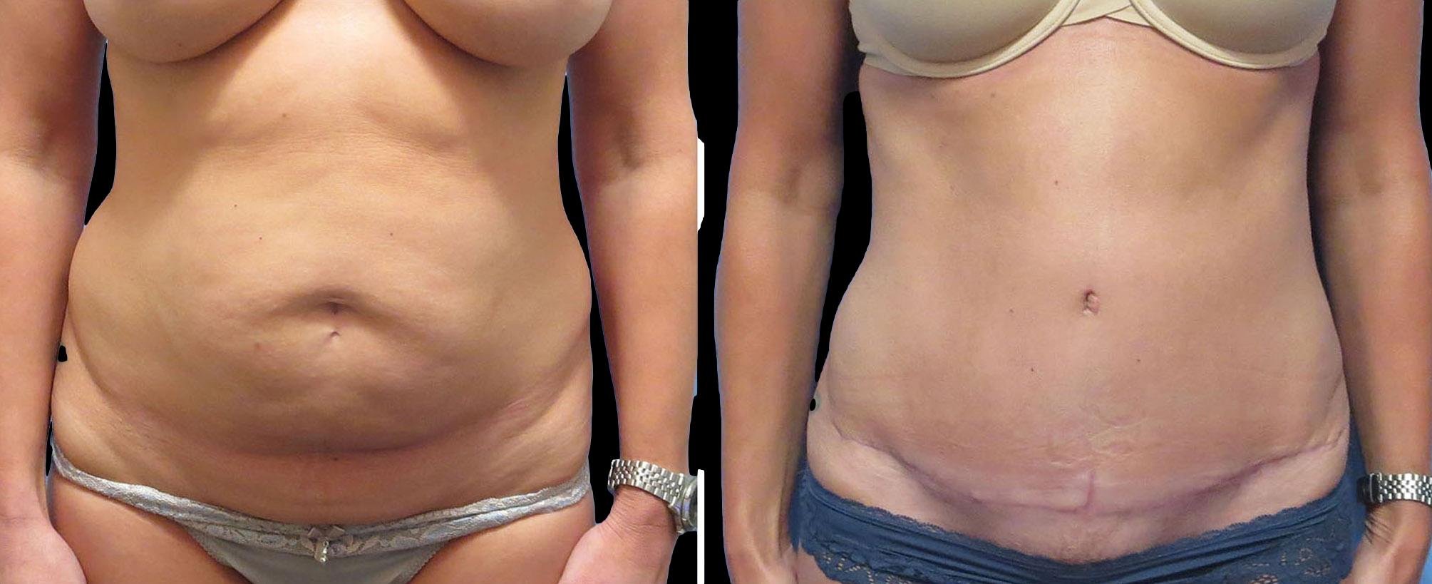 before and after abdominoplasty / tummy tuck