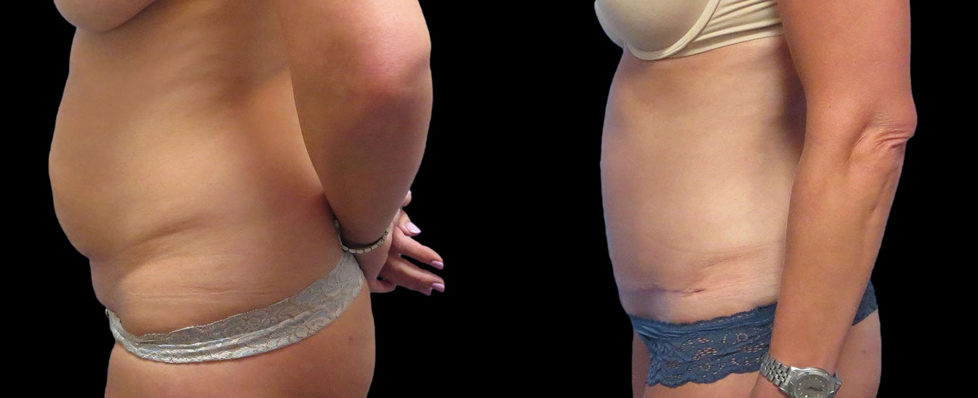 before and after abdominoplasty / tummy tuck