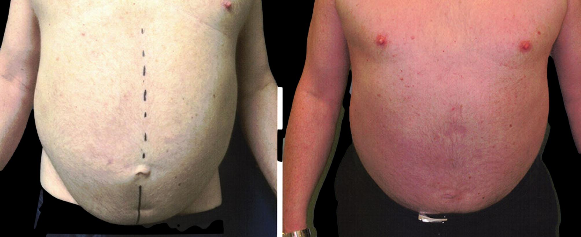 before and after abdominoplasty / tummy tuck
