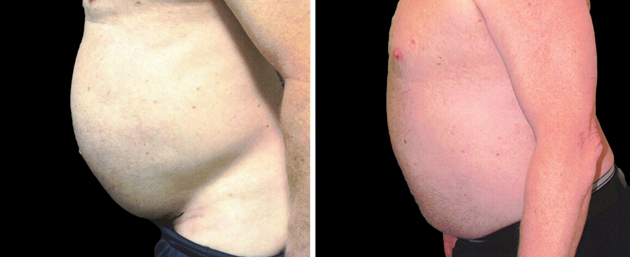 before and after abdominoplasty / tummy tuck