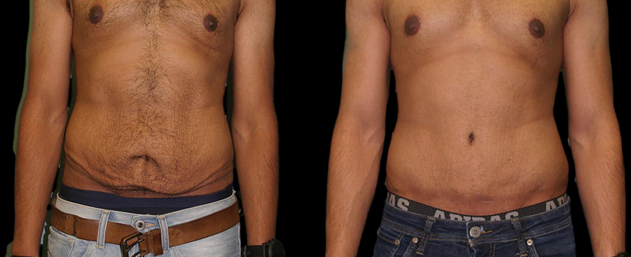 before and after abdominoplasty / tummy tuck