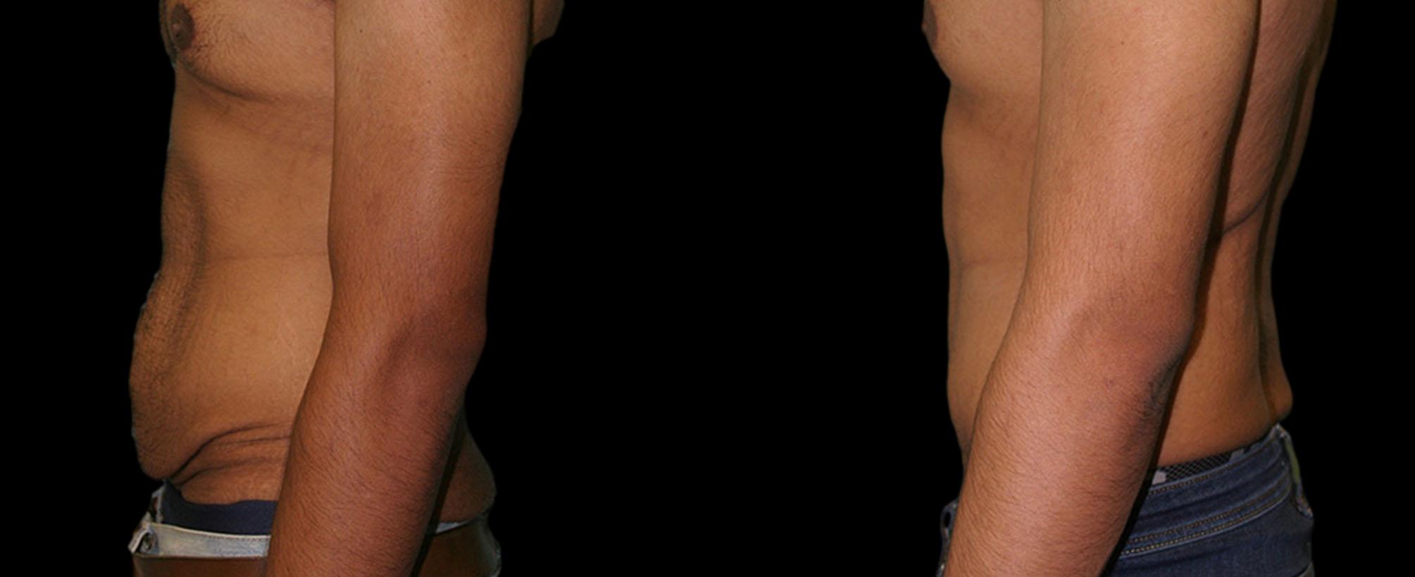 before and after abdominoplasty / tummy tuck