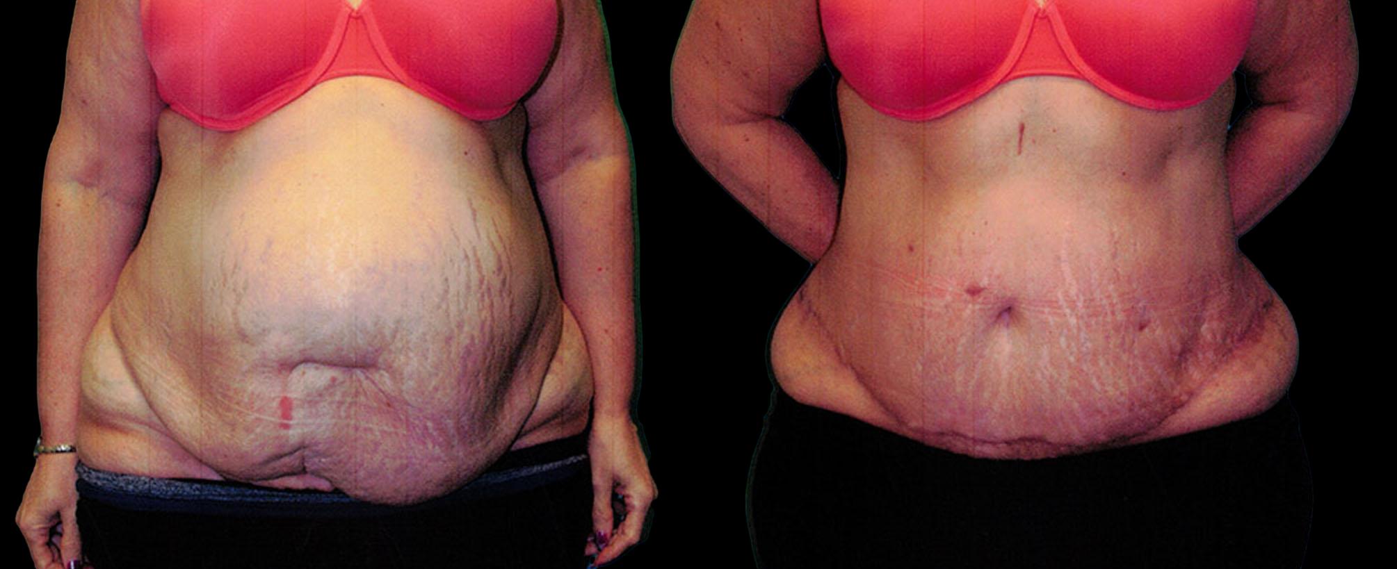 before and after abdominoplasty / tummy tuck