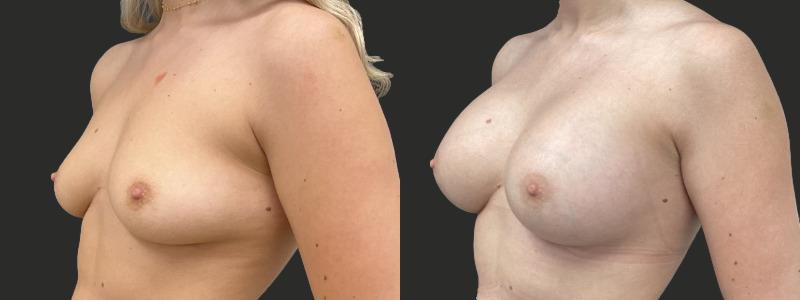 before and after breast augmentation
