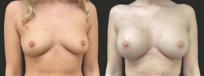 before and after breast augmentation
