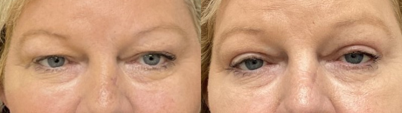 before and after blepharoplasty