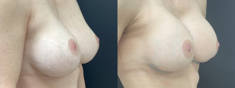 before and after breast revision