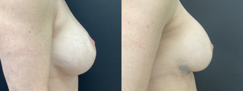 before and after breast revision