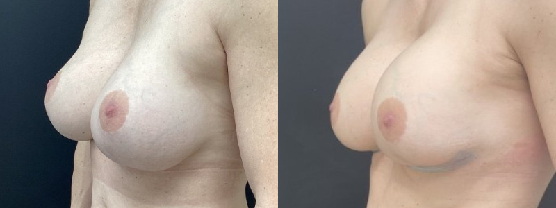 before and after breast revision