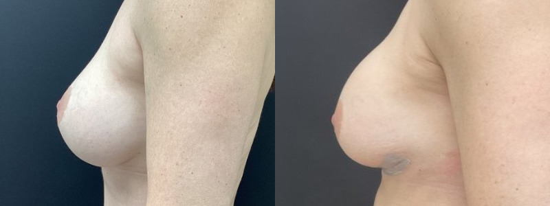 before and after breast revision
