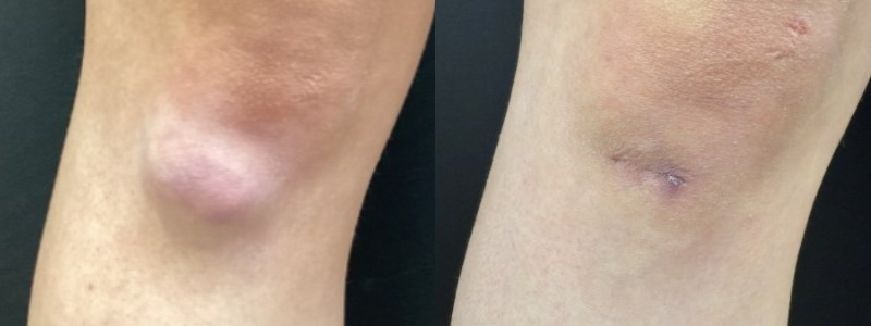 before and after lumps + bumps