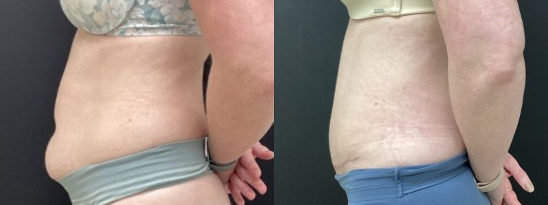 before and after abdominoplasty / tummy tuck