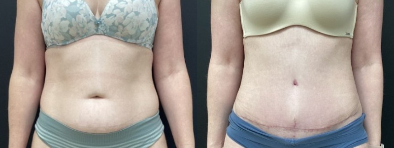 before and after abdominoplasty / tummy tuck