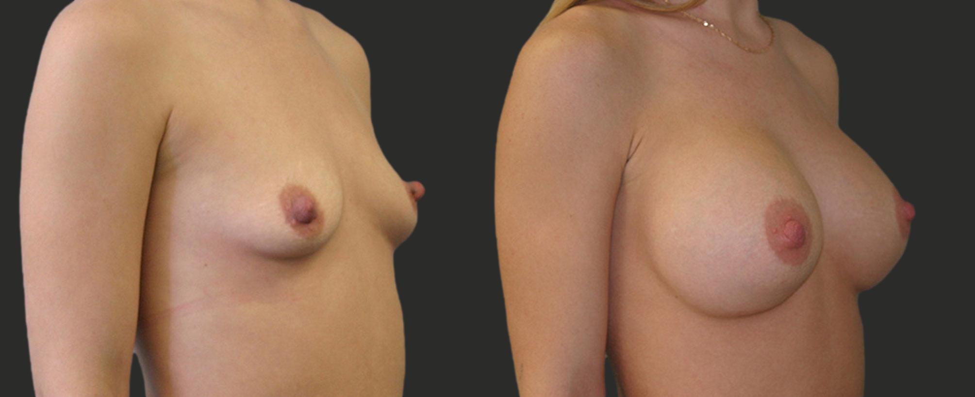 before and after breast augmentation