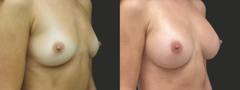 before and after breast augmentation