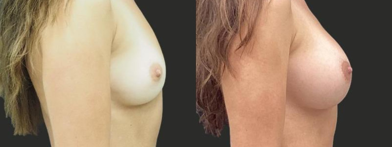 before and after breast augmentation