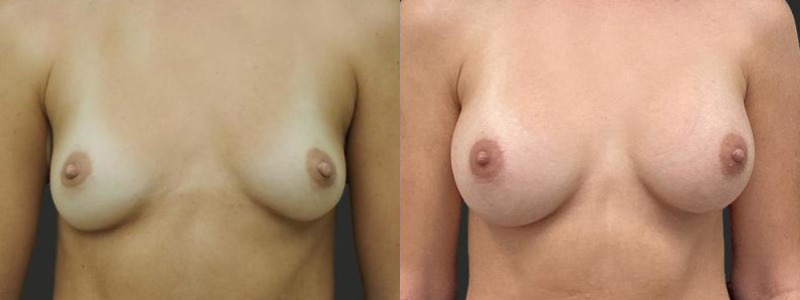 before and after breast augmentation