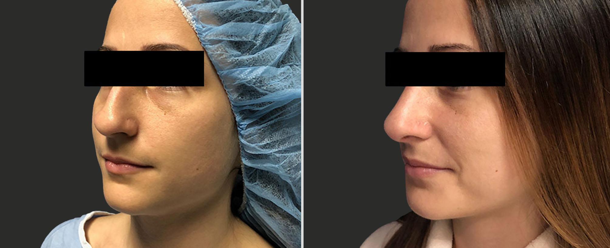 before and after rhinoplasty