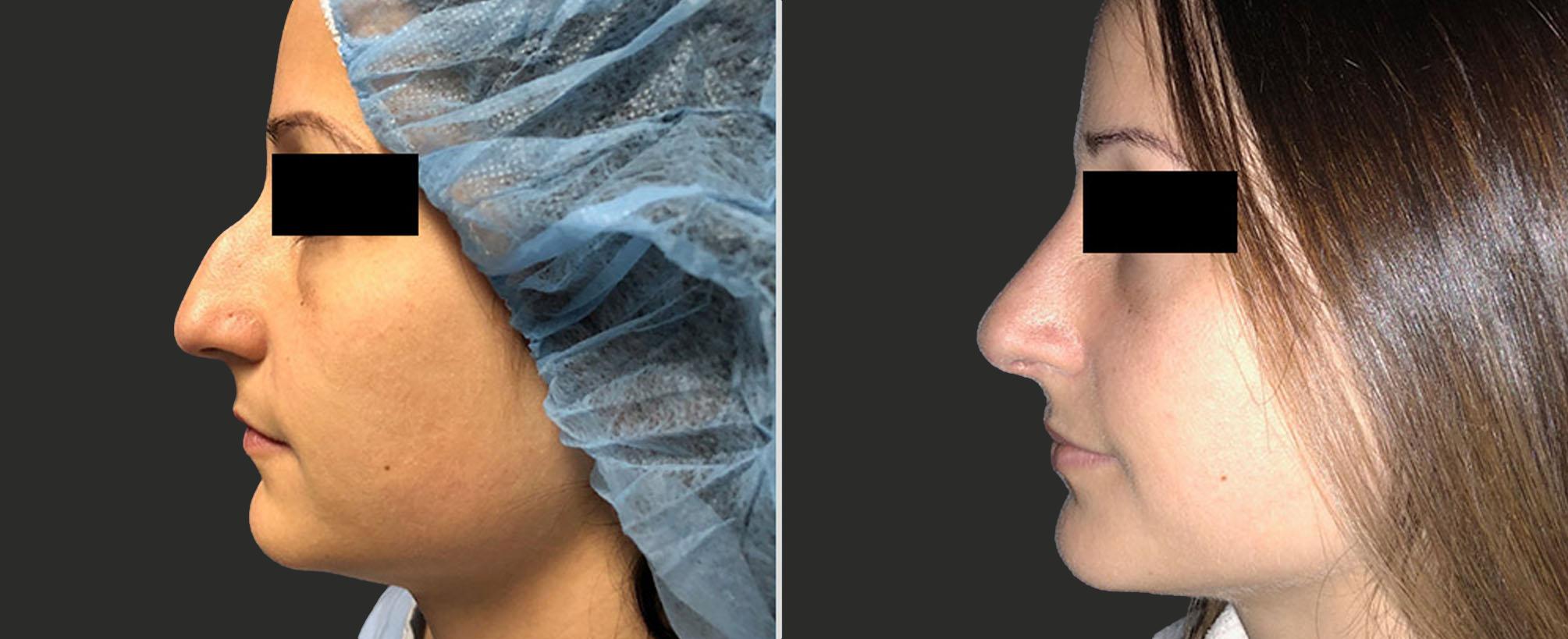 before and after rhinoplasty