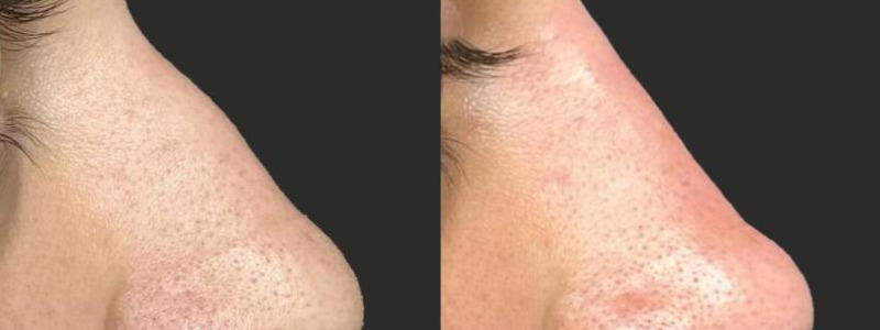 before and after rhinoplasty