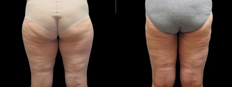 before and after thigh lift