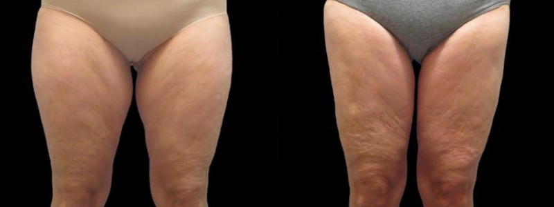 before and after thigh lift