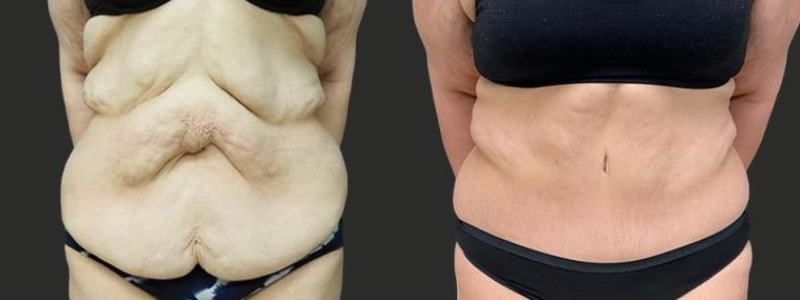 before and after abdominoplasty / tummy tuck