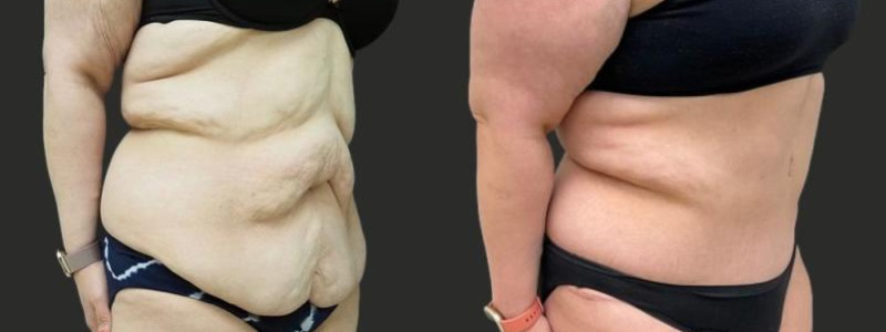 before and after abdominoplasty / tummy tuck