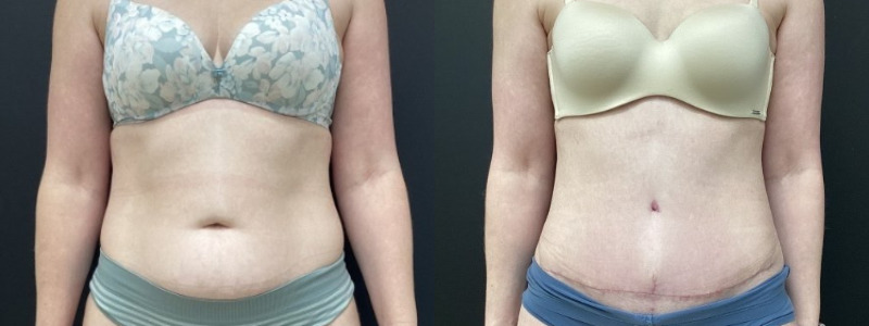 before and after abdominoplasty / tummy tuck