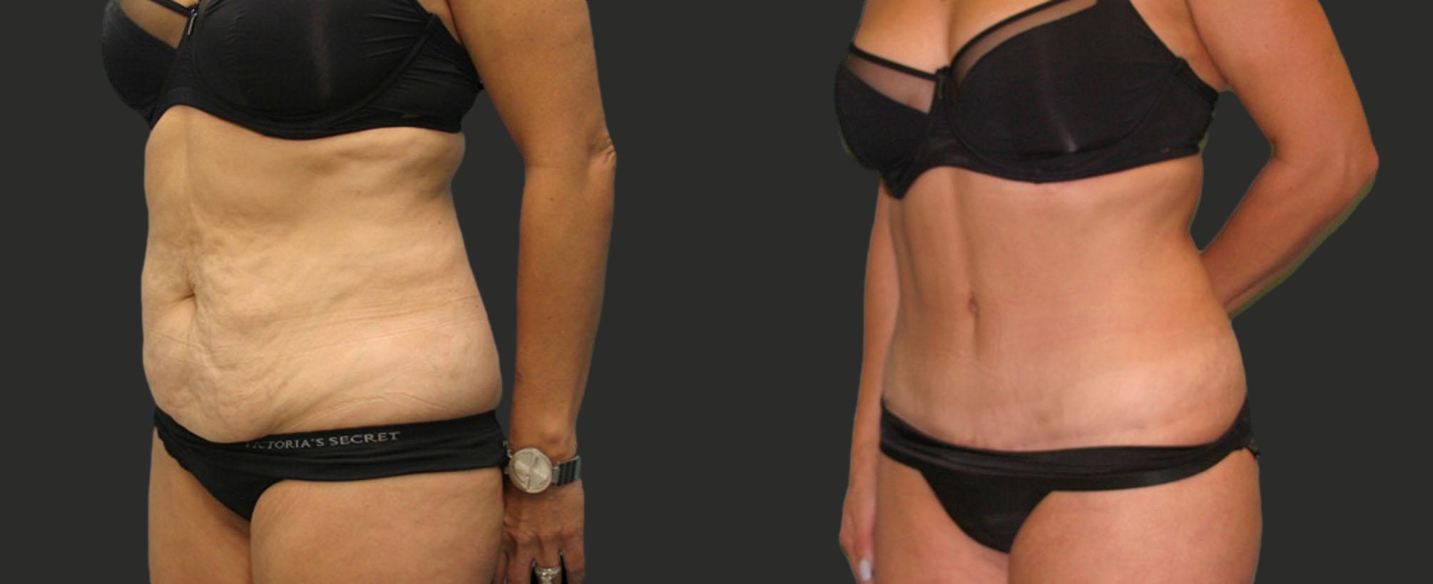 before and after abdominoplasty / tummy tuck