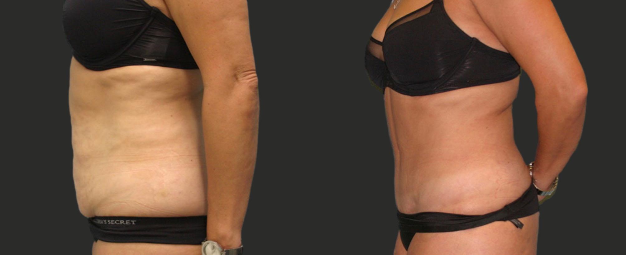 before and after abdominoplasty / tummy tuck
