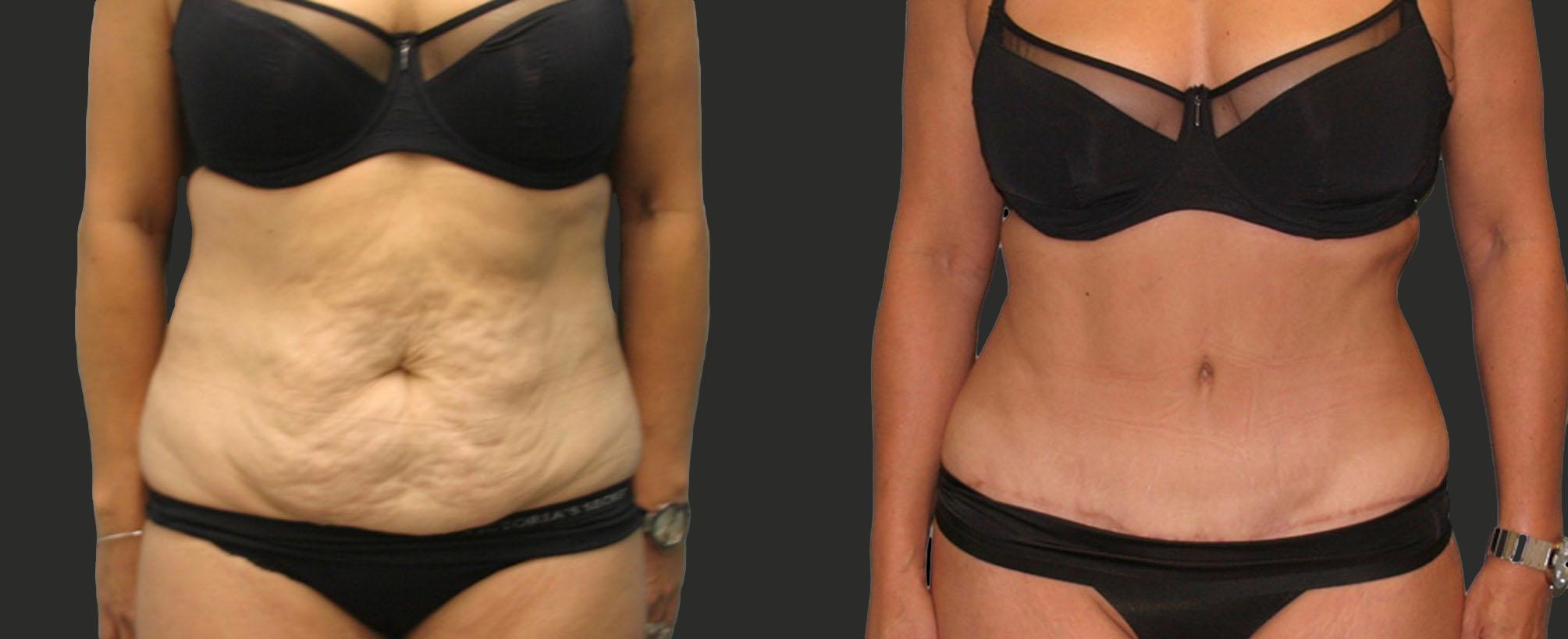 before and after abdominoplasty / tummy tuck