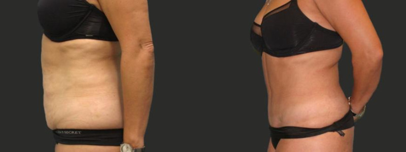before and after abdominoplasty / tummy tuck