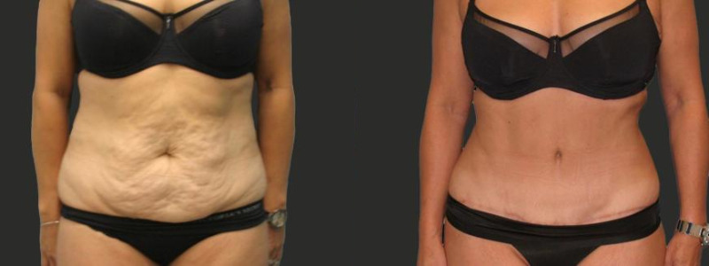 before and after abdominoplasty / tummy tuck