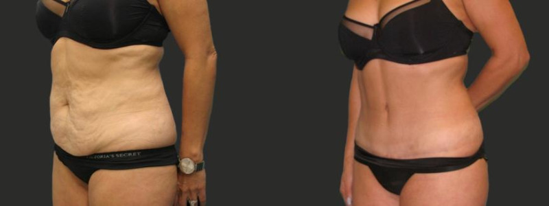 before and after abdominoplasty / tummy tuck