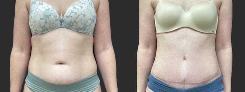 before and after abdominoplasty / tummy tuck