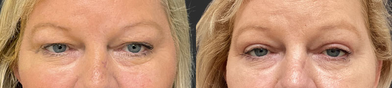 Blepharoplasty results, front view – case 26