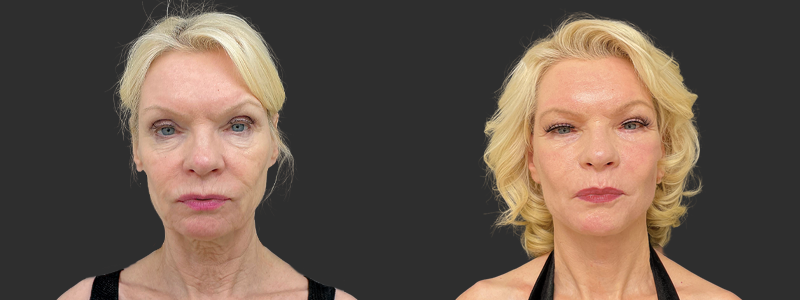 Face & neck lift results, front view – case 7