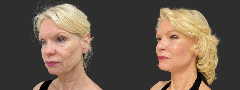 Face & neck lift results, left angle view – case 7, photo 1