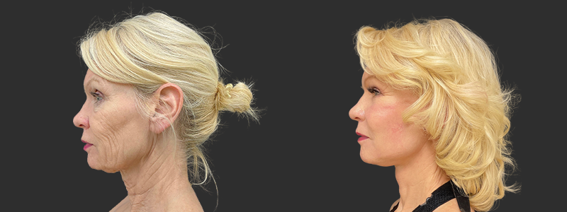 Face & neck lift results, left profile view – case 7