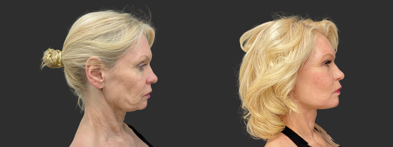 Face & neck lift results, right profile view – case 7