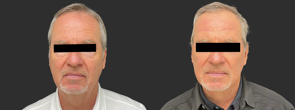 Before and after facelift and neck lift, front view – male patient