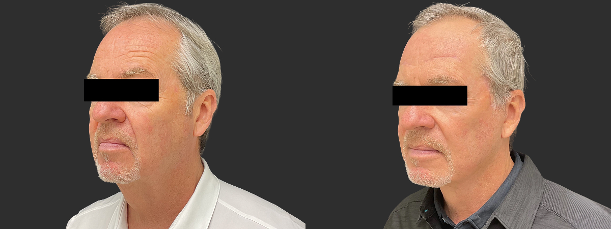 Before and after facelift and neck lift, left oblique view – male patient