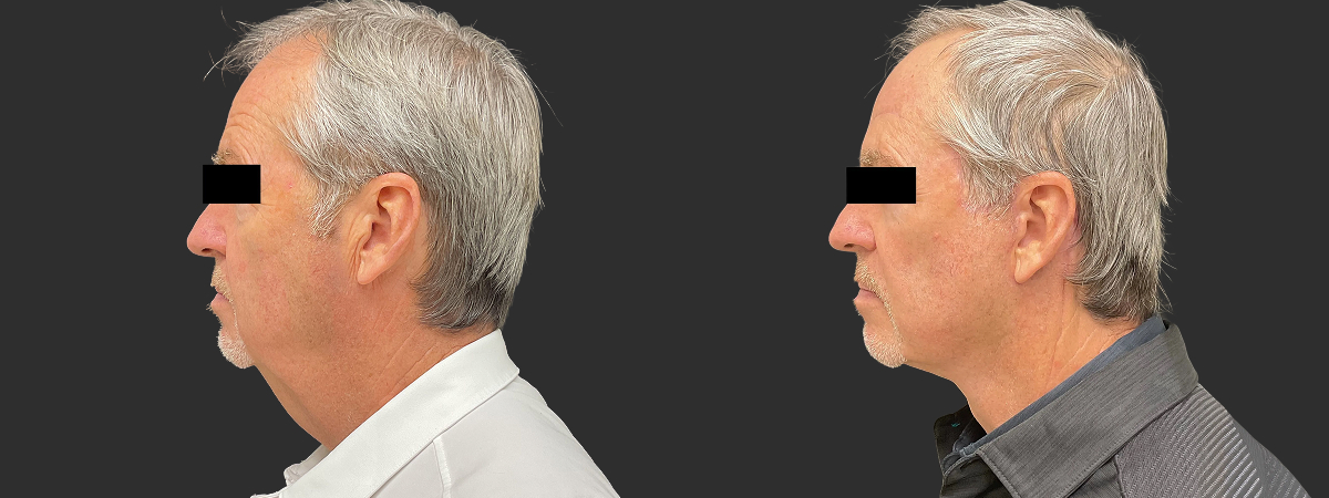 Before and after facelift and neck lift, left side view – male patient